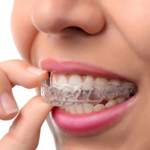 Types of Braces - Whistler Orthodontic Center